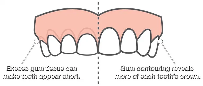 Gingival Contouring