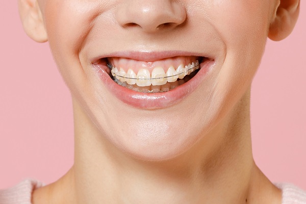 Transform Your Smile Today With Orthodontic Treatment